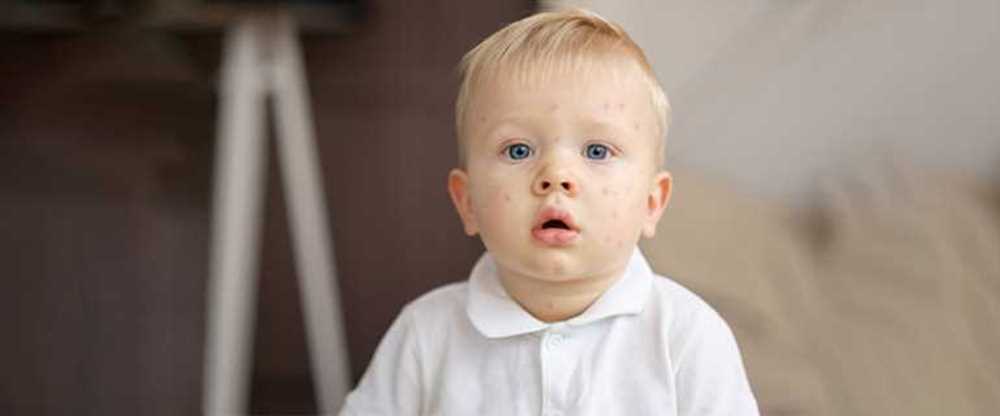 آبله مرغان در کودکان