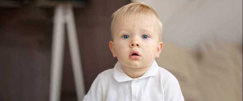 آبله مرغان در کودکان